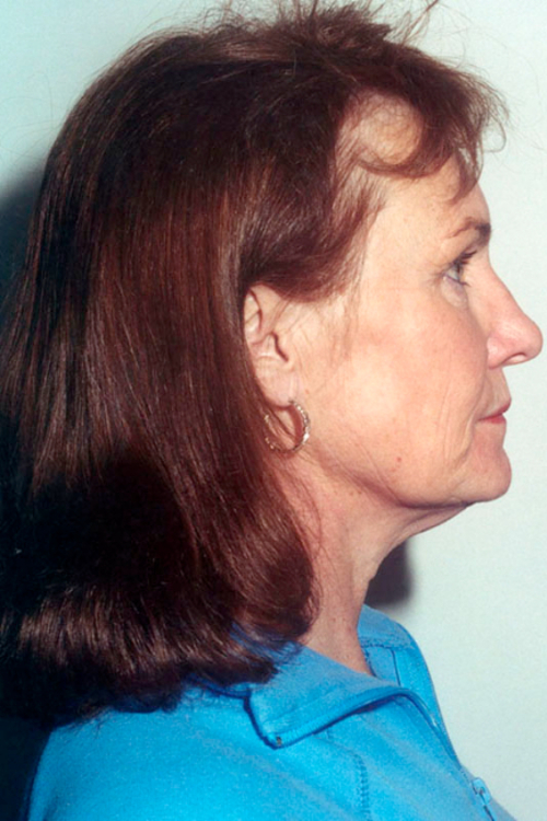 facelift1-3of6 Facelift